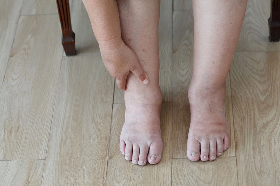 penyebab kaki bengkak pada lansia