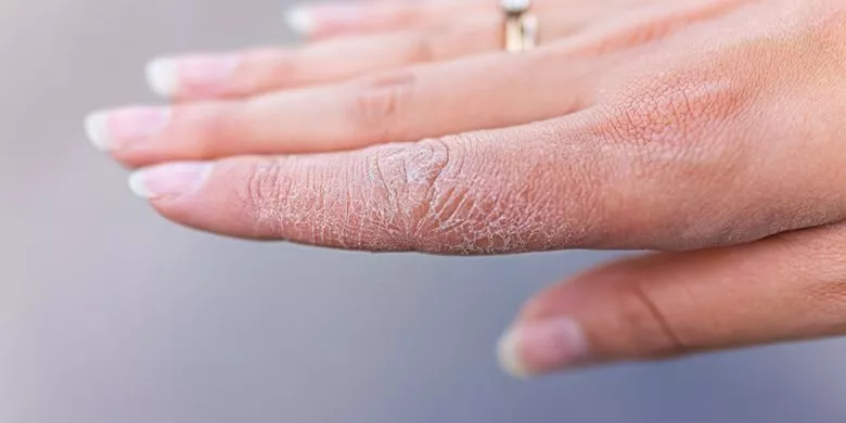 cara alami mengatasi kulit kering pada tangan dan kaki