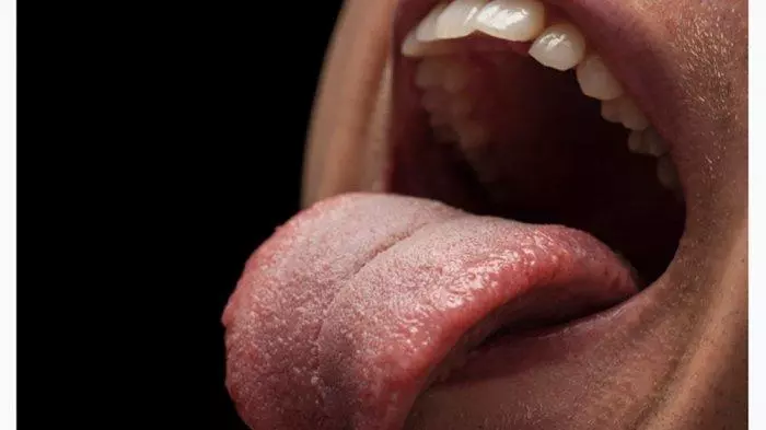cara mengobati sariawan di lidah