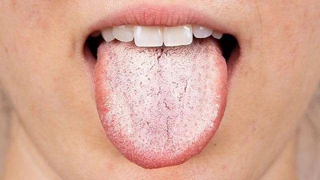 lidah warna putih
